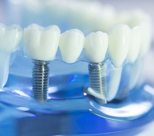 Bayonne Dental Implants