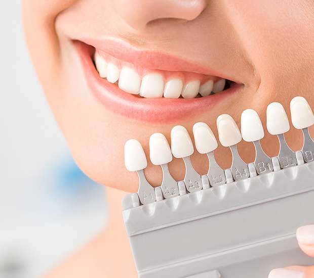 Bayonne Dental Veneers and Dental Laminates