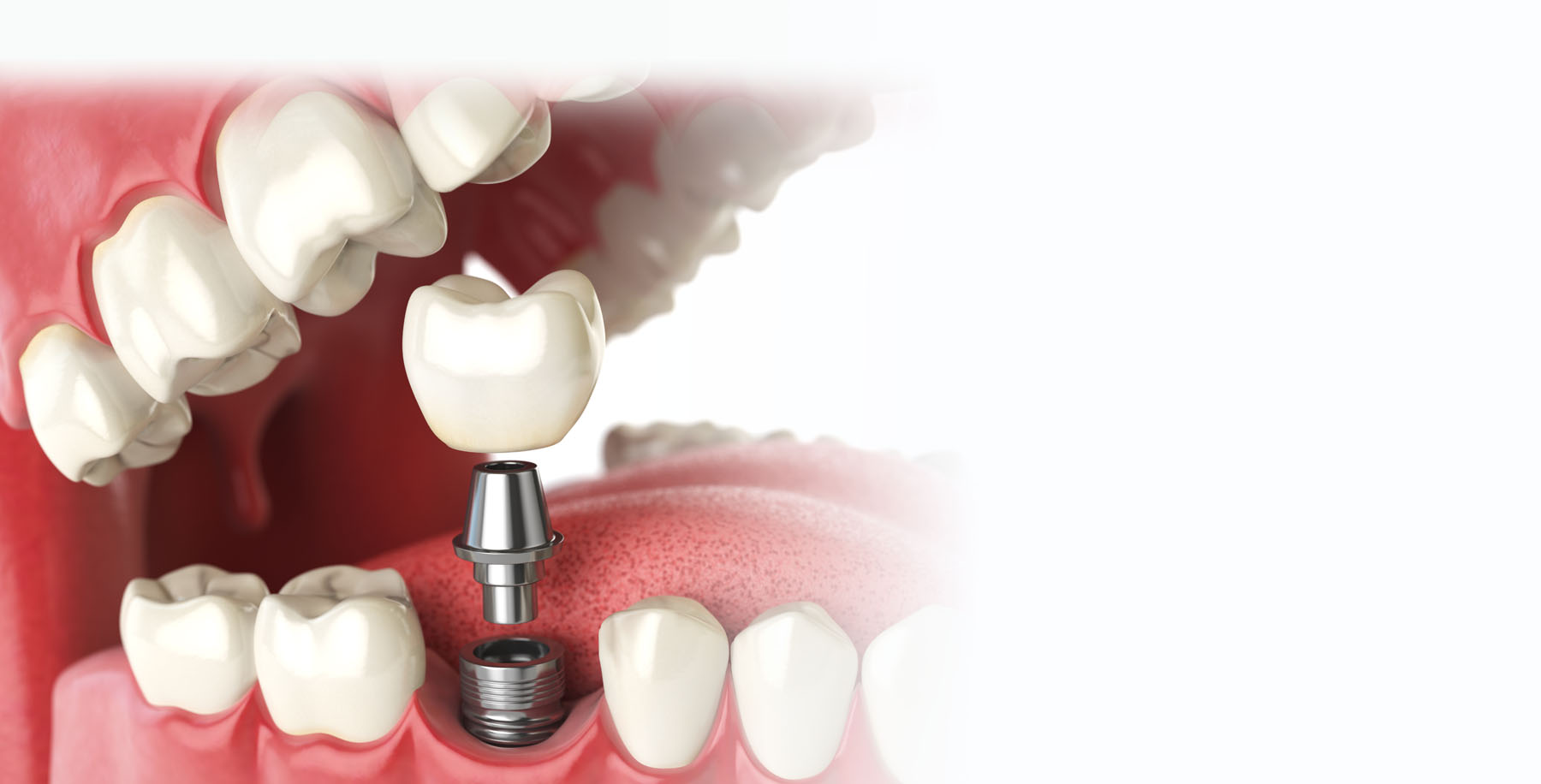 Full Dental Implants